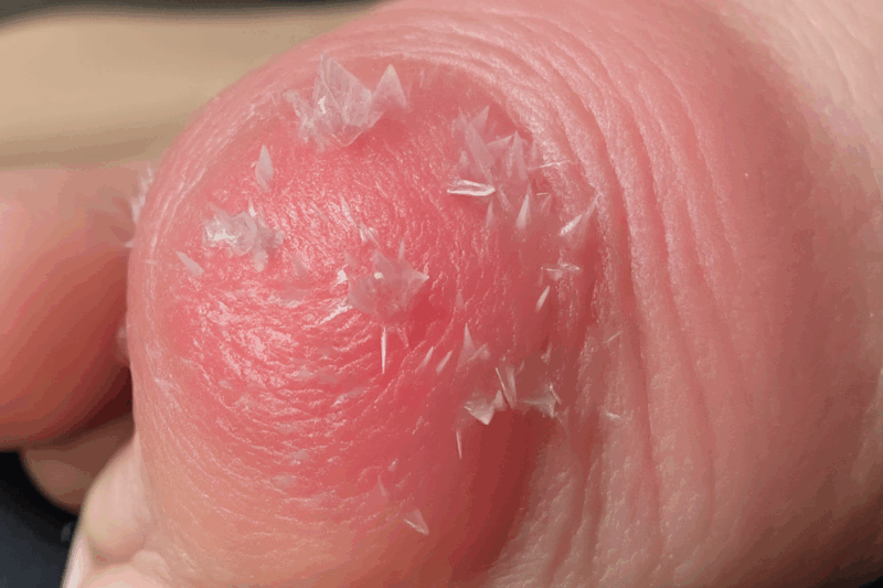 What Causes Gout? Unraveling the Mystery of Excruciating Joint Pain!