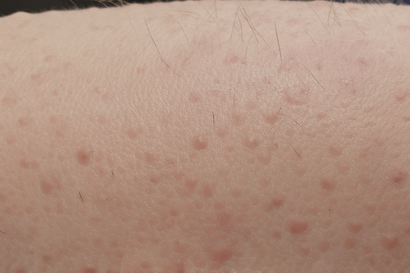 Why Do We Get Goosebumps? The Amazing Science Explained!