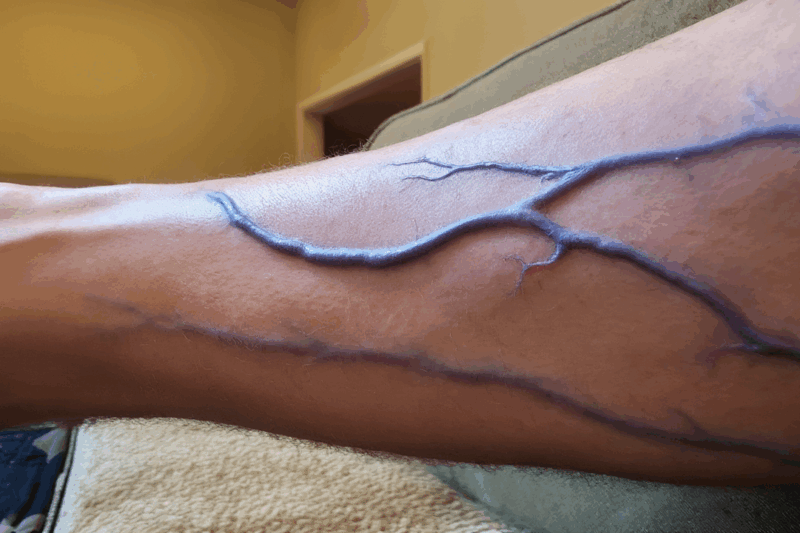 Why Do We Get Varicose Veins? The Truth About Those Bulging Lines!